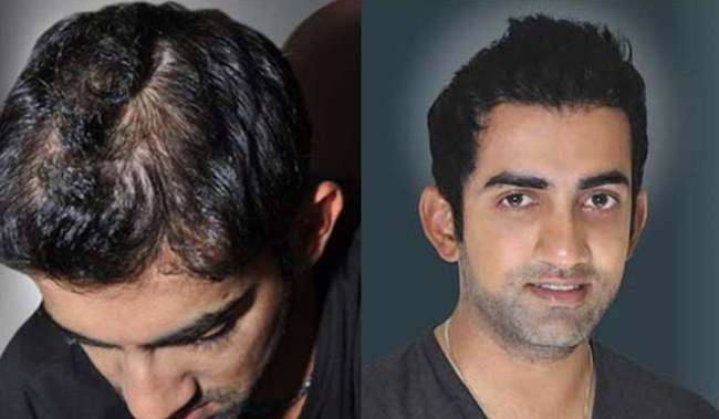 Top five cricketers who underwent hair transplant after severe hair fall
